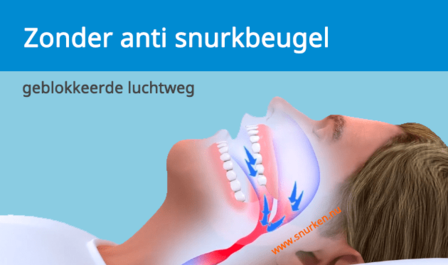 SomnoGuard AP2 snurkbeugel